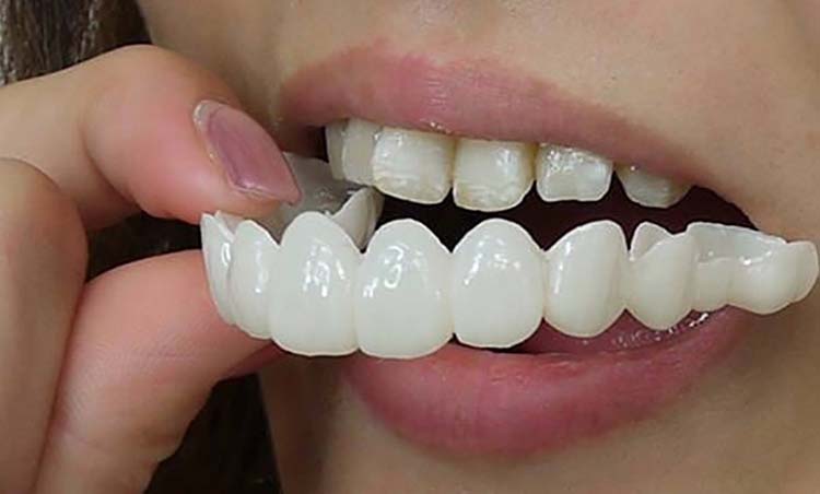 removable veneers brooklyn new york usa 11204